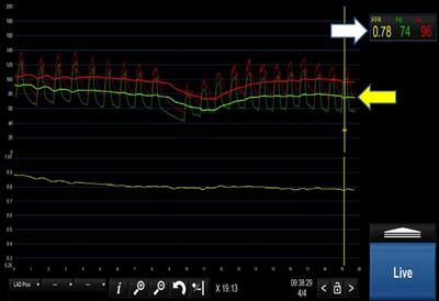 Intra-coronary physiology in contemporary percutaneous coronary intervention and anginal therapy with a focus on microvascular disease